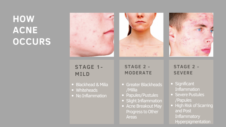 Acne And Acne Scars Lesprit Medical Clinic